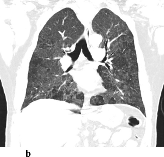 (a,b) - Hypersensitivity pneumonitis: 28-year-old female presented with chronic cough associated with shortness of breath dyspnea on exertion. She lives at home where her sister has an African gray parrot. CT shows widespread ground-glass opacities. There is hypoattenuation and hypovascularity of scattered secondary lobules (head cheese sign). Her clinical symptoms worsened and she was diagnosed with hypersensitivity pneumonitis.