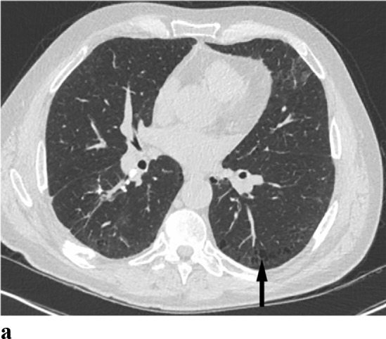 (a,b) - Desquamative interstitial pneumonitis: 54 year old male patient with long smoking history presented with declining pulmonary function. CT chest showed irregular linear opacities and small cysts in both lower lobes. Lung biopsy confirmed desquamative interstitial pneumonitis.