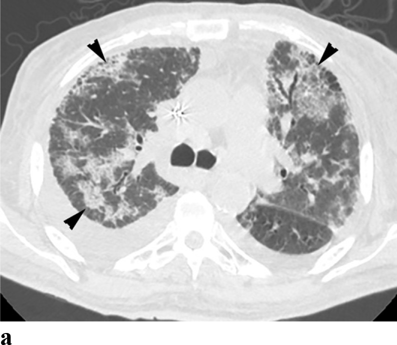 (a-c) - COVID with coexisting heart failure: A 69 year old male presented with acute on chronic CHF with ejection fraction of 28%. The patient tested positive for COVID-19. Note patchy peripherally distributed GGO’s (arrowheads). The patient also has moderate bilateral pleural effusions (arrows).