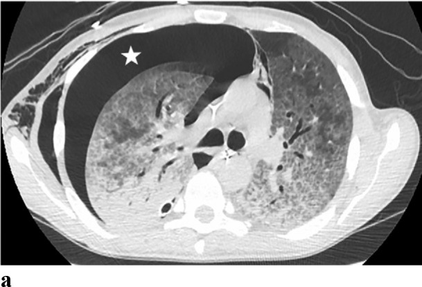 (a,b) - Pneumocystis carinii pneumonia: 32 yr old male with AIDS and a CD4 of 7 presented with respiratory arrest. CT demonstrates a moderate right pneumothorax (asterisk) and widespread ground glass and air space opacities.