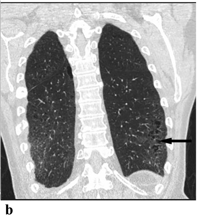 (a,b) - Desquamative interstitial pneumonitis: 54 year old male patient with long smoking history presented with declining pulmonary function. CT chest showed irregular linear opacities and small cysts in both lower lobes. Lung biopsy confirmed desquamative interstitial pneumonitis.