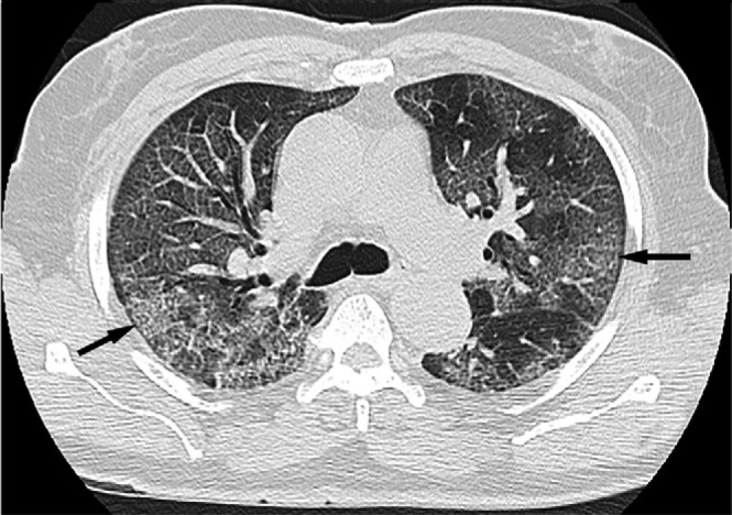 (a,b) COVID mimicking PAP with crazy paving appearance: A 77 year old male was admitted for fever and cough. CT chest axial lung windows demonstrates crazy paving appearance (arrows) mimicking pulmonary alveolar proteinosis. The patient’s PCR was positive for COVID-19.