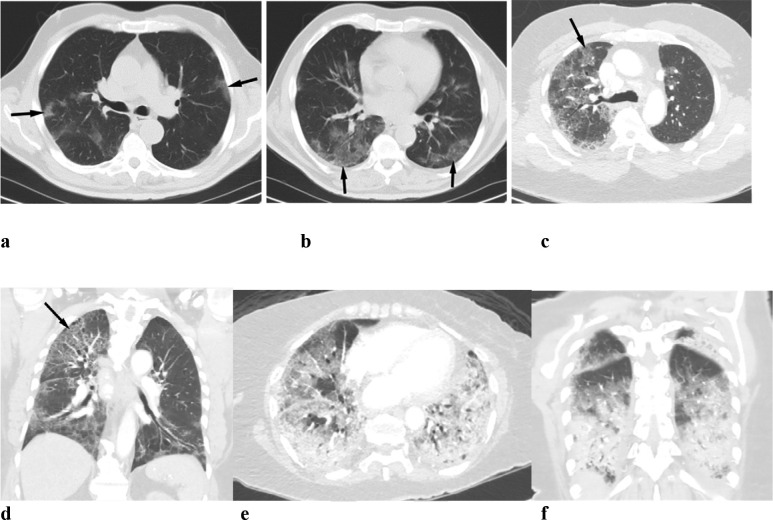 (a,b) COVID 19 pneumonia: A 77-year old male patient presented with low grade fever and shortness of breath since 1 week. Chest CT shows hazy opacities in both lungs predominantly peripheral in distribution (arrows). These are the typical features of the disease that have been reported with COVID-19 infection. (c,d) COVID crazy paving: The patient is a 58 year old male presents with lightheadedness. CXR and CT chest supported viral pneumonia diagnosis. His COVID testing was positive. CT shows crazy paving pattern (arrow).) e,f (COVID consolidation: 86 year old female with past medical history of hypertension, hyperlipidemia and type 2 diabetes presented with generalized weakness and cough. The patient was found to be positive for COVID. The patient passed away 9 days after admission. Chest CT shows widespread alveolar consolidation with typical radiological findings of ARDS.