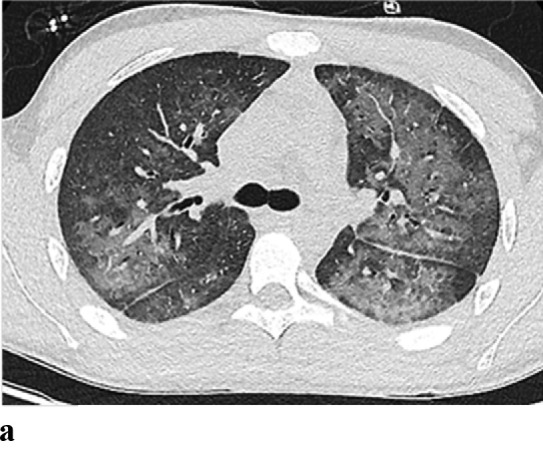 (a,b) - E-cigarette or vaping product use associated lung injury: 18 year old male with a history of vaping presented with fever, leukocytosis and pleuritic chest pain. Chest radiograph demonstrates lower lobe predominant air space opacities. CT chest shows multiple perihilar and lower lobe predominant ground glass opacities.