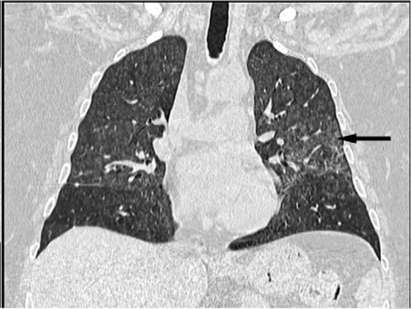 (a, b) Diffuse alveolar hemorrhage: 47 yr old female w recurring hemoptysis. CT demonstrates widespread ground glass opacities in both lungs (arrow).