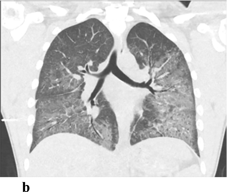 (a,b) - E-cigarette or vaping product use associated lung injury: 18 year old male with a history of vaping presented with fever, leukocytosis and pleuritic chest pain. Chest radiograph demonstrates lower lobe predominant air space opacities. CT chest shows multiple perihilar and lower lobe predominant ground glass opacities.