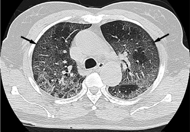 (a,b) COVID mimicking PAP with crazy paving appearance: A 77 year old male was admitted for fever and cough. CT chest axial lung windows demonstrates crazy paving appearance (arrows) mimicking pulmonary alveolar proteinosis. The patient’s PCR was positive for COVID-19.