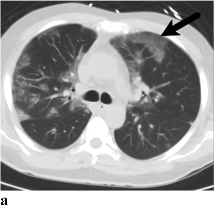 (a,b) - Organizing Pneumonia: 43-year-old, Caucasian male with a history of follicular lymphoma, status post chemotherapy. He was admitted for respiratory failure. Lung biopsy yielded organizing pneumonia. He did well on steroids and was discharged.