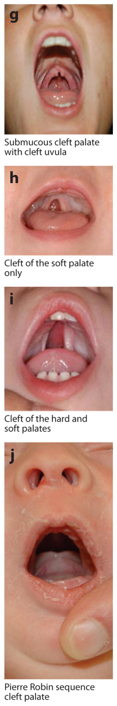 The Evolution of Human Genetic Studies of Cleft Lip and Cleft Palate - PMC