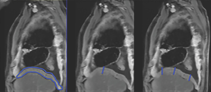 Multiplanar postcontrast MR images obtained in a patient with right-sided malignant pleural mesothelioma (MPM). (a) Axial MR images obtained at the upper (left), middle (middle), and lower (right) levels show pleural thickness measurements (blue lines): Pavg (average pleural thickness) and Pmax (sum of maximal pleural thicknesses at the three levels). (b) Sagittal MR image shows the fissure and Fmax (maximal fissure thickness) (blue outlines). (c) Sagittal MR image shows the diaphragm (right image) and diaphragmatic thickness measurements (middle and right images): Davg (average diaphragmatic thickness) and Dmax (maximal diaphragmatic thickness). (d) Axial (far left), sagittal (second from left image), coronal (third from left image), and three-dimensional (far right) MR images show segmentation (shaded blue) of the right-sided MPM.