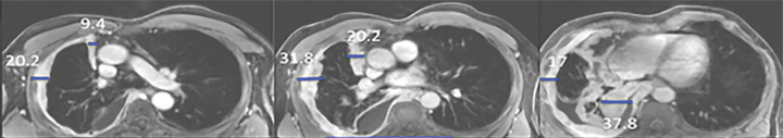 Multiplanar postcontrast MR images obtained in a patient with right-sided malignant pleural mesothelioma (MPM). (a) Axial MR images obtained at the upper (left), middle (middle), and lower (right) levels show pleural thickness measurements (blue lines): Pavg (average pleural thickness) and Pmax (sum of maximal pleural thicknesses at the three levels). (b) Sagittal MR image shows the fissure and Fmax (maximal fissure thickness) (blue outlines). (c) Sagittal MR image shows the diaphragm (right image) and diaphragmatic thickness measurements (middle and right images): Davg (average diaphragmatic thickness) and Dmax (maximal diaphragmatic thickness). (d) Axial (far left), sagittal (second from left image), coronal (third from left image), and three-dimensional (far right) MR images show segmentation (shaded blue) of the right-sided MPM.