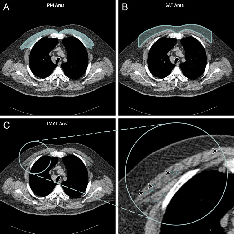 Axial chest CT examination in a 54-year-old participant. A, On the axial noncontrast chest CT image, the pectoralis muscle (PM) area was segmented and measured in the section above the aortic arch. B, The subcutaneous adipose tissue (SAT) area as the area between the PM and the skin surface on the same section was also measured and the attenuation of pixels in the SAT area was used to determine the individualized threshold for the intermuscular adipose tissue (IMAT). C, The IMAT within the PM was segmented as the areas with Hounsfield units below this threshold for the IMAT (arrowheads).