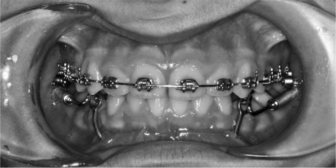 Figure 2. Application of the skeletal anchoraged Forsus Fatigue Resistant Device appliance.