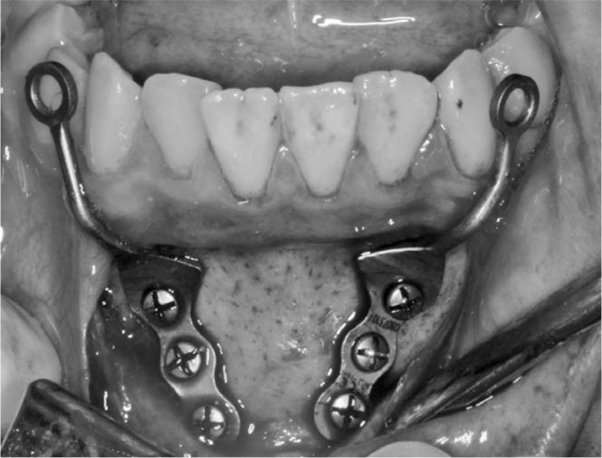 Figure 1. The miniplates inserted on the mandibular symphysis.