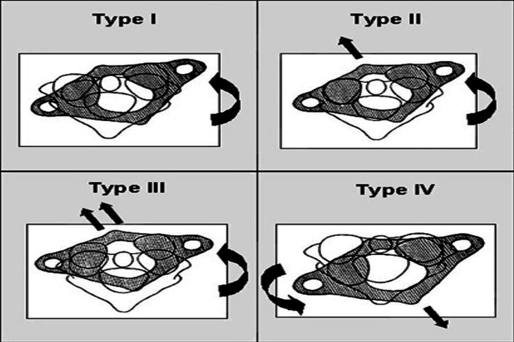 Diagnostic Approach and Treatment Options for Pediatric Cases of Grisel ...