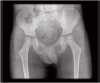 <b>Fig. 1a</b>: Plain AP radiograph of the hips.
