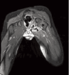<b>Fig. 2</b>: MRI of both hips with contrast T1 coronal image with
contrast -, showing abscesses (rim enhancing lesions (A)
arising from the inner aspect of left ischium and crossing
the ischium (I). N= neck of femur.