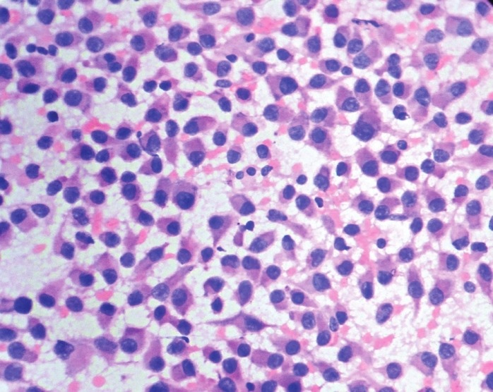 Benign breast myoepithelioma - PMC