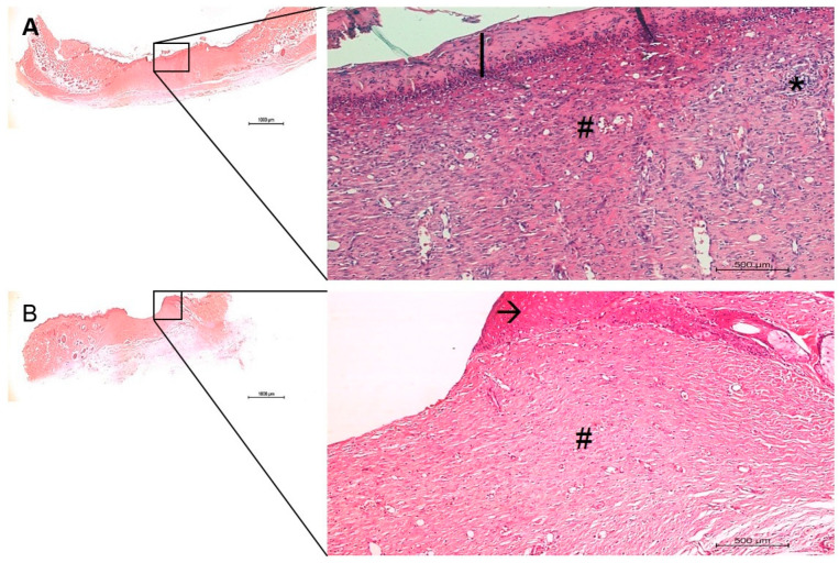 A New Dermal Substitute Containing Polyvinyl Alcohol With Silver 