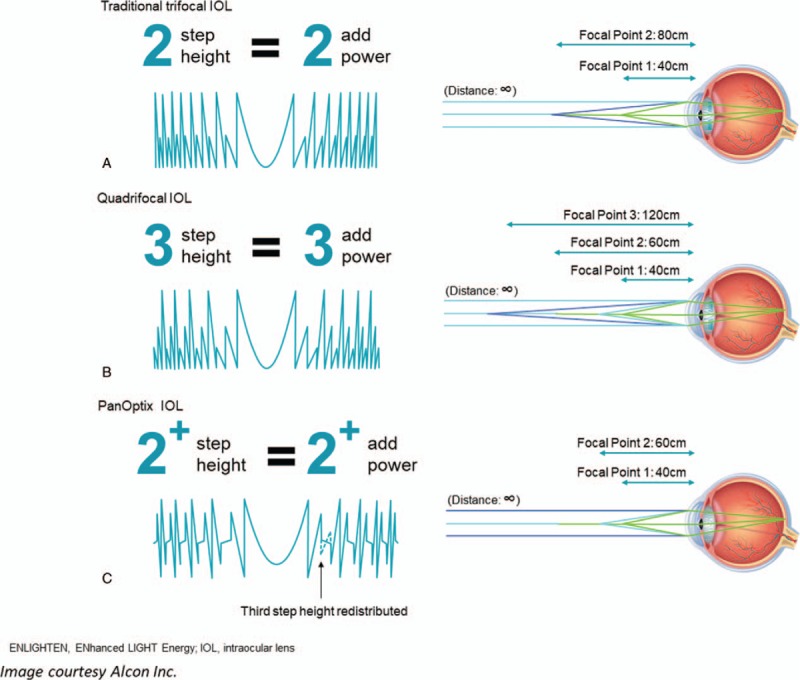 AcrySof IQ PanOptix Intraocular Lens Versus Extended Depth of Focus ...