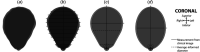 Patient-specific models generated for one patient. (a) The MRI segmented model was created by hand-segmenting MRI image stacks, whereas the multimeasured, averaged, and elliptical models are based on parametric dimension measurements. All parametric models are based on previous methods for the uterine sagittal shape, with different approaches to creating the coronal shape [21]. (b) The multimeasured model uses 45 measurements to define the coronal shape (15 intra-uterine diameters, 15 right uterine wall thicknesses, and 15 left uterine wall thicknesses). (c) The averaged model uses the same measurements outlined in previous work (one intra-uterine diameter and one uterine wall thickness) but utilizes an averaged at-term uterine shape, [21]. (d) The elliptical model uses an elliptical coronal shape, as is assumed in previous work [21]. Dimension measurements taken from clinical images are denoted by solid black lines, and locations in the averaged parametric based on measurement trends are denoted by a dashed black line.