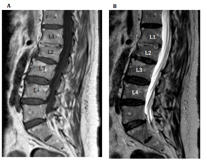 Figure 1. T1 (A) and T2 (B) weighted sagittal Magnetic Resonance Imaging of the lumbar spine displaying a fusion of the L1 and L2 vertebral bodies.