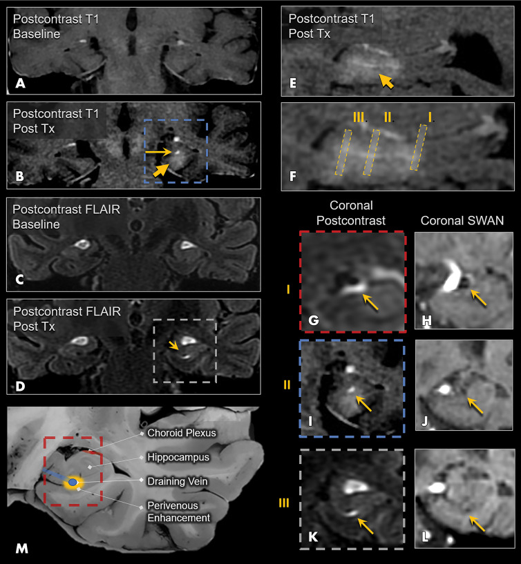 Perivenular enhancement pattern observed immediately after treatment (Tx) in a 72-year-old woman with Alzheimer disease. A, Coronal postcontrast T1-weighted MRI scan at baseline and, B, coronal postcontrast T1-weighted MRI scan obtained immediately after treatment show parenchymal contrast enhancement in the hippocampus and entorhinal cortex (short arrow), as well as a more avid focus of enhancement in the hippocampal fissure along the course of the hippocampal sulcus vein (long arrow). Coronal postcontrast fluid-attenuated inversion recovery (FLAIR) MRI scans at, C, baseline and, D, immediately after treatment show perivenous enhancement (arrow) around the intrahippocampal sulcal vein. E, Sagittal postcontrast T1-weighted MRI scan obtained immediately after treatment shows parenchymal and intense linear perivenular enhancement in the hippocampal fissure. F, Zoomed-in version of E shows coronal levels I, II, and III. G, Coronal postcontrast FLAIR MRI scan at the level of the basal vein of Rosenthal shows patent venous lumen with surrounding ringlike perivenous enhancement (arrow). H, Coronal susceptibility-weighted MRI (SWI) scan shows the basal vein of Rosenthal. I, Coronal postcontrast T1-weighted MRI scan at the level of the hippocampal sulcus vein shows contrast enhancement surrounding the vein. J, Coronal SWI scan shows the hippocampal sulcus vein (arrow) as a small black dot. K, Coronal postcontrast FLAIR MRI scan at the level of the intrahippocampal sulcal vein shows comma-shaped contrast enhancement surrounding this small vein. L, Coronal SWI scan shows the intrahippocampal sulcal vein. M, Schematic image shows the perivenular enhancement pattern, which was observed on immediate posttreatment images in all three participants who underwent treatment. SWAN = T2* susceptibility-weighted angiography.