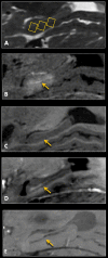 MRI scans show spatiotemporal pattern of perivenular enhancement in a 73-year-old woman with Alzheimer disease. A, Sagittal T2-weighted pretreatment image shows three selected target sites within the hippocampus (rectangles). B, Sagittal postcontrast T1-weighted image immediately after treatment shows parenchymal contrast enhancement within the targeted hippocampus and entorhinal cortex, as well as more hyperintense linear enhancement within the hippocampal fissure (arrow) longitudinally along the course of the hippocampal veins. C, Sagittal precontrast T1-weighted image obtained 24 hours after treatment shows clearance of gadolinium-containing contrast material from both the interstitial and the perivenous and perivascular spaces (arrow). D, Sagittal postcontrast T1-weighted image obtained 24 hours after treatment shows perivenular enhancement within the hippocampal fissure (arrow) along the course of the veins, indicating perivenous blood–meningeal barrier permeability. There is no parenchymal enhancement at this time point because of closure of the blood-brain barrier. E, Sagittal minimal intensity projection image obtained by using axial T2* susceptibility-weighted angiographic imaging data shows the course of hippocampal veins, which appear as a linear dark stripe within the hippocampal fissure (arrow). Perivenous enhancement seen in B and D paralleled the course of these veins, as further shown in Figure 5.
