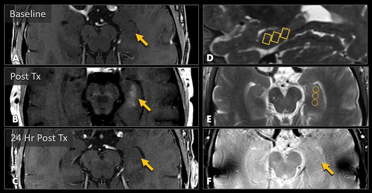 MRI scans show blood-brain barrier (BBB) opening and closure within targeted brain volumes in a 73-year-old woman with Alzheimer disease. Postcontrast T1-weighted images at, A, baseline, B, immediately after treatment (Tx), and, C, 24 hours after treatment show parenchymal contrast material extravasation (arrow in B) due to BBB opening locally at the treatment sites and BBB closure with resolution of parenchymal contrast enhancement on repeat gadobutrol administration 24 hours later (arrow in C). D, Sagittal T2-weighted image shows three 5 × 5 × 7-mm target volumes demarcating the treated areas within the hippocampus and entorhinal cortex. E, Target sites shown on axial T2-weighted image. F, Axial image obtained with the T2* gradient-echo sequence immediately after treatment shows no evidence of signal dropout to suggest hemorrhage at the treated areas.