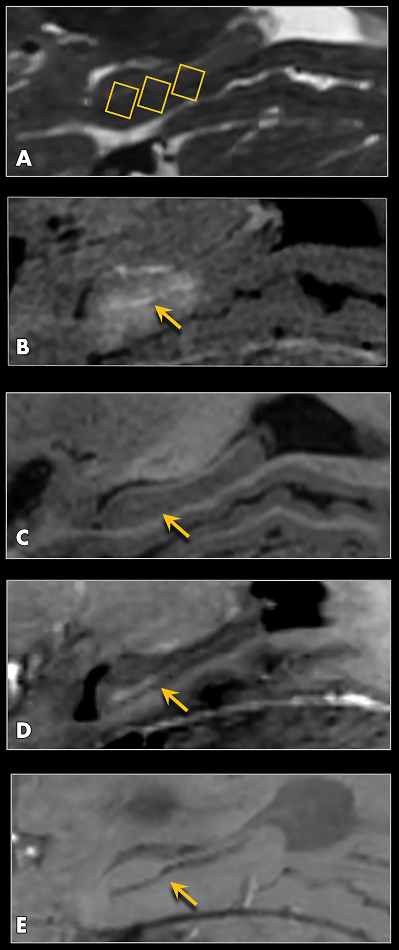 MRI scans show spatiotemporal pattern of perivenular enhancement in a 73-year-old woman with Alzheimer disease. A, Sagittal T2-weighted pretreatment image shows three selected target sites within the hippocampus (rectangles). B, Sagittal postcontrast T1-weighted image immediately after treatment shows parenchymal contrast enhancement within the targeted hippocampus and entorhinal cortex, as well as more hyperintense linear enhancement within the hippocampal fissure (arrow) longitudinally along the course of the hippocampal veins. C, Sagittal precontrast T1-weighted image obtained 24 hours after treatment shows clearance of gadolinium-containing contrast material from both the interstitial and the perivenous and perivascular spaces (arrow). D, Sagittal postcontrast T1-weighted image obtained 24 hours after treatment shows perivenular enhancement within the hippocampal fissure (arrow) along the course of the veins, indicating perivenous blood–meningeal barrier permeability. There is no parenchymal enhancement at this time point because of closure of the blood-brain barrier. E, Sagittal minimal intensity projection image obtained by using axial T2* susceptibility-weighted angiographic imaging data shows the course of hippocampal veins, which appear as a linear dark stripe within the hippocampal fissure (arrow). Perivenous enhancement seen in B and D paralleled the course of these veins, as further shown in Figure 5.