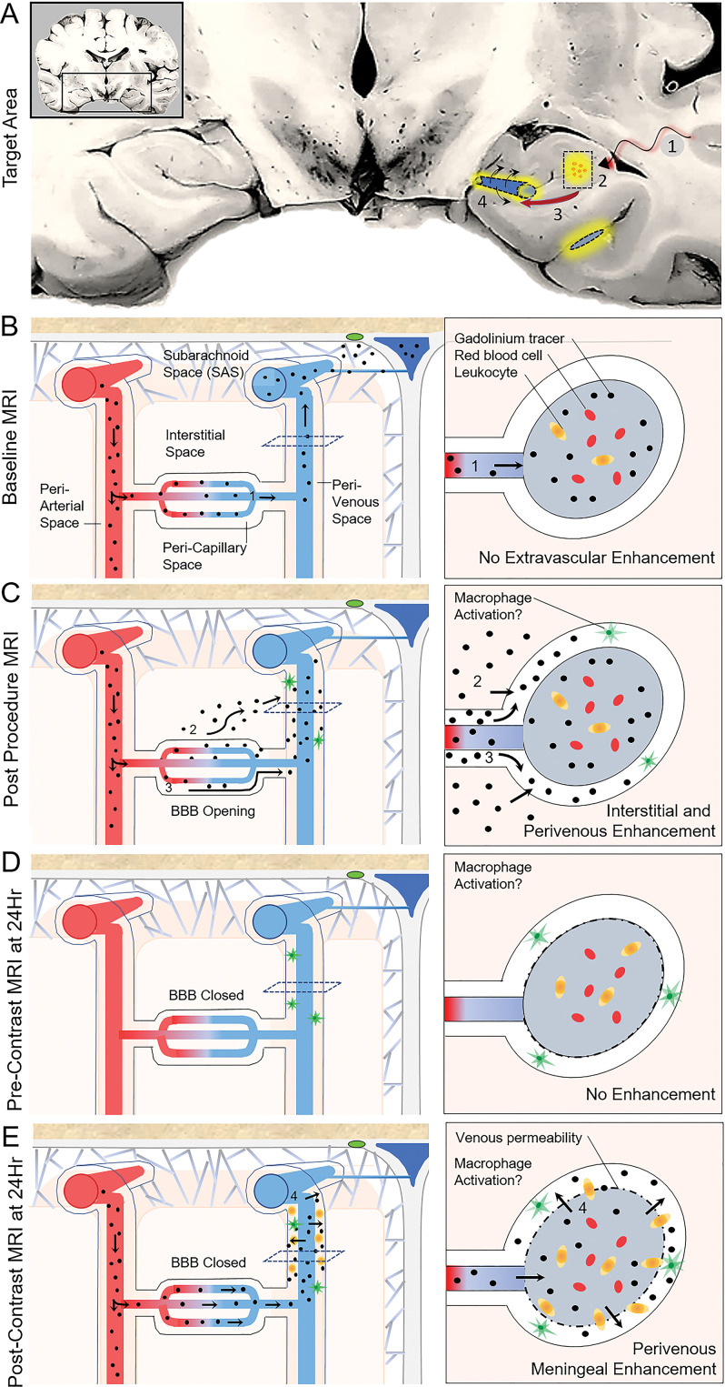 Observed tracer movement pattern after focused ultrasound-induced blood-brain barrier (BBB) opening and proposed glymphatic efflux route in humans. A, Coronal schematic view through the temporal lobes summarizes procedural effects of BBB opening. 1, Focused ultrasound energy was delivered, along with intravenous microbubbles, to the hippocampal target site (boxed area). 2, Contrast extravasation from capillaries into the interstitial space (yellow) indicates BBB opening within the targeted volume. 3, Contrast material flows downstream from the interstitial space to the perivenular space, along the proposed glymphatic efflux route, resulting in perivenous enhancement. 4, Reactive venous permeability is proposed to account for contrast material leakage into the perivenous sheath, suggesting a physiologic perivenular neuroimmune reaction. B, Normal flow of contrast material during baseline homeostatic state. With closed (intact) BBB, contrast material travels through the intravascular compartment and exits the cranial cavity via the dural venous sinuses and along the dura. C, Flow of contrast material during focused ultrasound–induced BBB opening. Because of acquired permeability of the capillary walls, gadobutrol extravasates from the intravascular compartment into the pericapillary or interstitial space and flows downstream to perivenous spaces. D, At 24 hours after treatment, precontrast images demonstrate gadolinium clearance from both the brain parenchyma and perivascular spaces due to rapid transit related to bulk fluid and solute flow. E, Postcontrast imaging at 24 hours after focused ultrasound. Notably, after repeat intravenous gadobutrol administration, no intraparenchymal contrast enhancement is seen because of closure of the BBB. However, gadolinium-based contrast agent accumulation reappears around the draining veins, suggesting permeability of the postcapillary venules and meningeal veins.