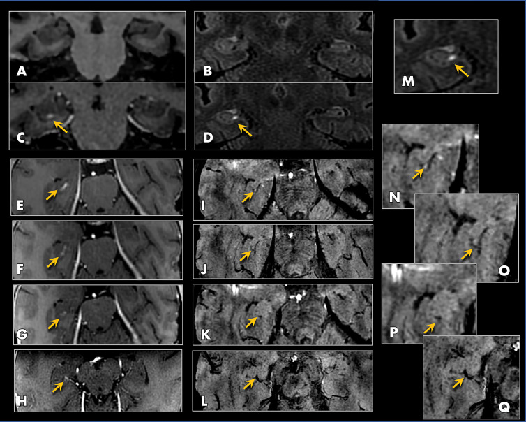 MRI scans show perivenular enhancement after gadobutrol clearance and blood-brain barrier (BBB) closure at 24 hours after treatment in a 61-year-old woman with Alzheimer disease. Precontrast coronal, A, T1-weighted and, B, fluid-attenuated inversion recovery (FLAIR) images, both obtained 24 hours after treatment (at same time point as Fig 3, C), show absence of contrast enhancement in the hippocampus and perivascular space after BBB closure. Postcontrast coronal, C, T1-weighted and, D, FLAIR images, both obtained 24 hours after treatment, show enhancement along the course of the hippocampal sulcal vein (arrows). This enhancement, shown on serial axial T1-weighted sections in, E–H (arrows), was present longitudinally along the course of the hippocampal veins and could be followed posteriorly to the basal vein of Rosenthal (H). I–L, T2* susceptibility-weighted angiography (SWAN) images, corresponding to the same levels as E–H, show blooming susceptibility effects of the hippocampal venous structures (arrows) from the same participant, coinciding with the region of linear enhancement. This perivenous enhancement indicates blood–meningeal barrier permeability and occurred transiently after treatment before complete resolution at all treated sites. M, Same area as in D, zoomed on the right hippocampus, shows perivenous enhancement (arrow). N–Q, Zoomed axial SWAN images (I–L) show the hippocampal venous structures (arrows).