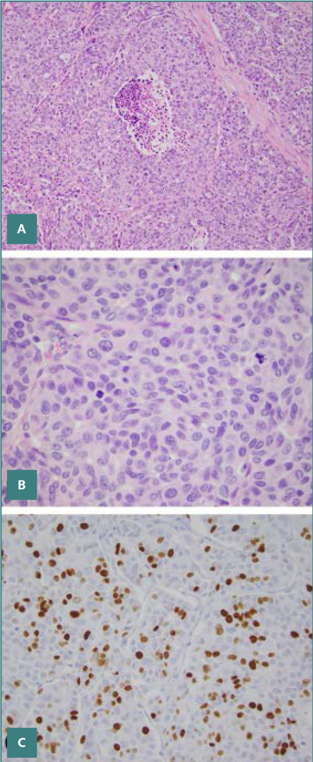 WHO 2022 updates on follicular cell and c-cell derived thyroid neoplasm ...