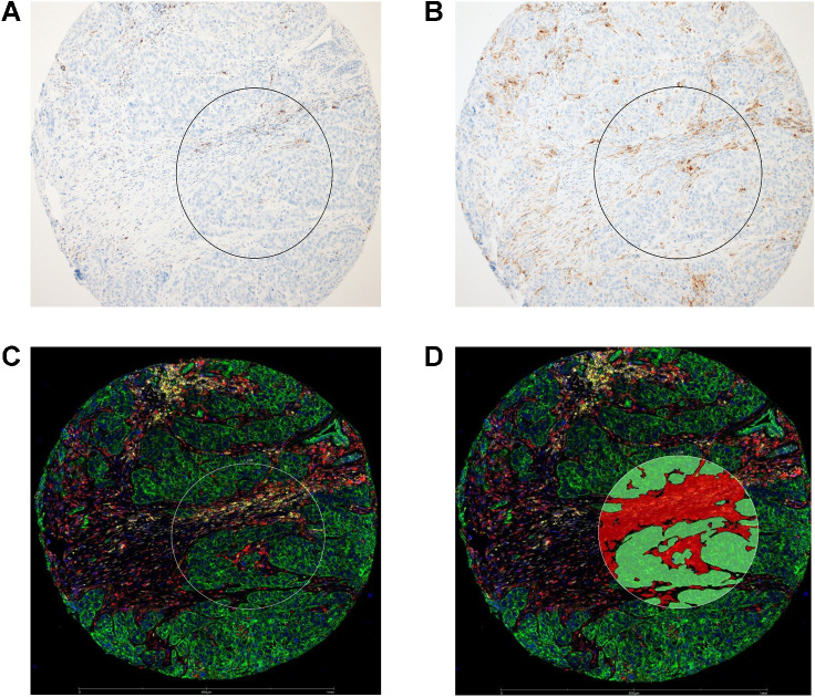 Figure 2. Micrographs of a representative tissue core in TNBC TMA stained with PD-L1 SP142 (A) or PD-L1 22C3 (B) antibody clones, highlighting PD-L1–positive tumor-associated ICs. C, Composite digital image of the same tissue core from DSP study, annotated with a 600-μm region-of-interest (white circle), and then segmented (D) into a cytokeratin+ (green fluorophore) Intraepithelial tumor segment (green overlay), and adjacent cytokeratin-/SYTO13 nuclear dye+ (blue fluorophore) Stroma segment (red overlay).