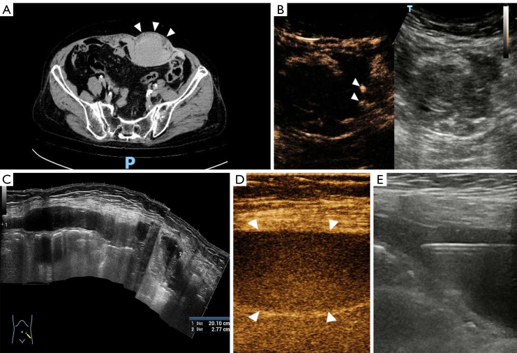 Real-time evaluation of active bleeding severity in soft-tissue ...