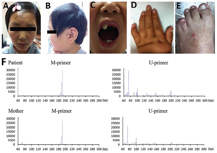 A Novel Nonsense Mutation of PHF6 in a Female with Extended Phenotypes ...