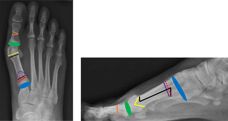 Hallux Valgus - PMC