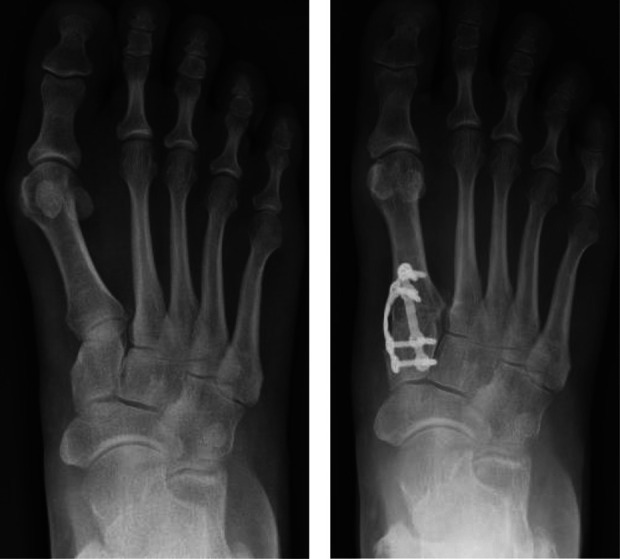 Hallux Valgus - PMC