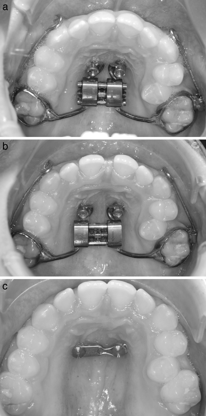 Figure 1. (a) Hybrid hyrax appliance in situ. Rigid sectional wires (stainless steel; diameter, 1.2 mm) were welded to the buccal side of the molar bands. A hook at the canine region enables orthopedic force application. (b) Situation after 1 week of expansion. Due to distraction of the midpalatal suture, a diastema mediale occurred. (c) Situation after removal of the hybrid hyrax. A modified plate was inserted for retention of maxillary transverse width.