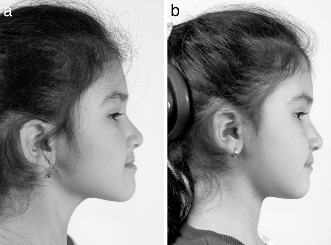 Figure 2. (a) Profile of an 8-year-old girl before treatment. (b) Profile after maxillary protraction of 7 months.