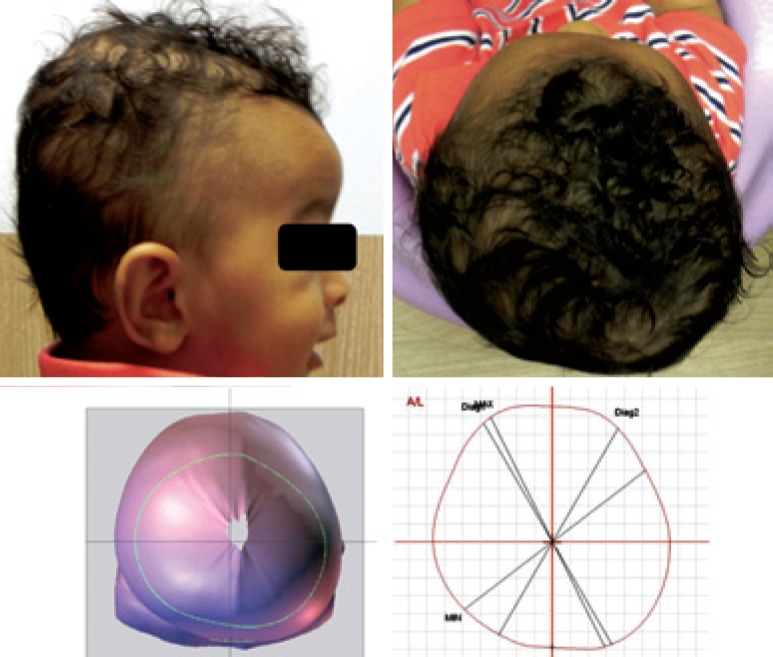 Plagiocephaly and brachycephaly treatment with cranial orthosis: a case ...