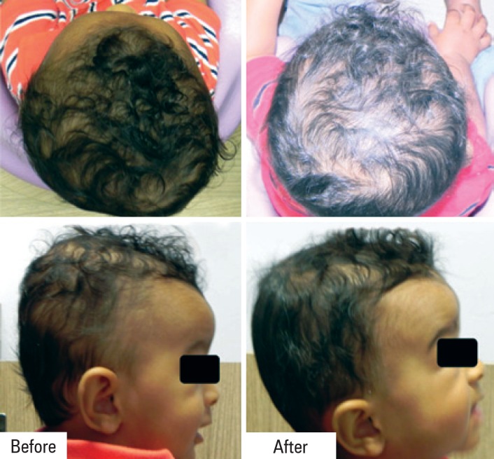 Plagiocephaly and brachycephaly treatment with cranial orthosis: a case ...