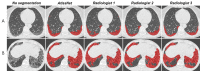 Comparison between automated and manual segmentations in, A, a 52-year-old woman with systemic sclerosis–related interstitial lung disease and, B, a 38-year-old man with systemic sclerosis–related interstitial lung disease. Contouring of these diseased areas was similar as performed by the algorithm and the three radiologists.