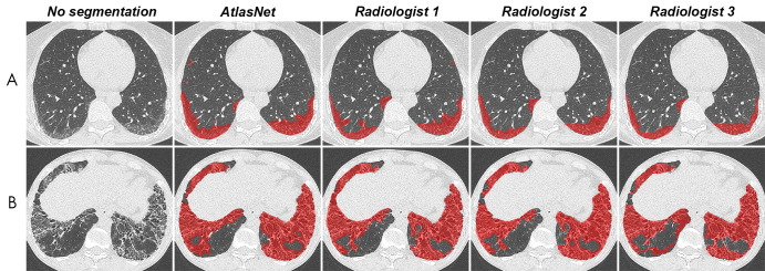 Comparison between automated and manual segmentations in, A, a 52-year-old woman with systemic sclerosis–related interstitial lung disease and, B, a 38-year-old man with systemic sclerosis–related interstitial lung disease. Contouring of these diseased areas was similar as performed by the algorithm and the three radiologists.