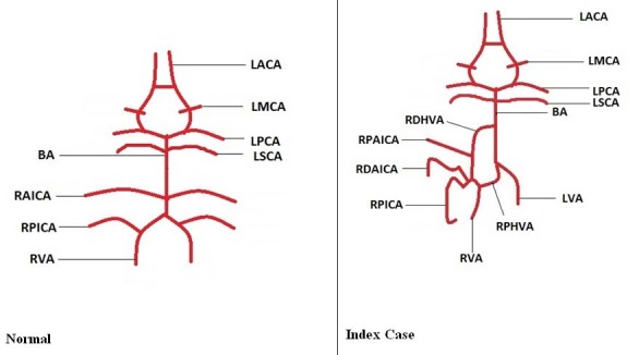 Duplicated and Hypoplastic V4 Segment of Vertebral Artery along with ...