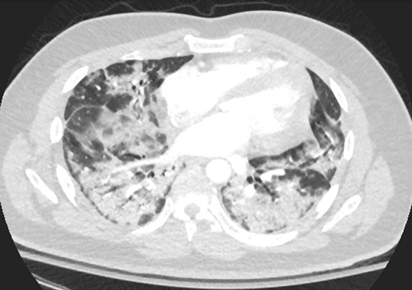 Axial chest CT scan following intravenous contrast material administration in the lower lungs of a 30-year-old male former smoker with a history of asthma who presented with fever, cough, and left lower back pain 3 weeks after symptom onset. CT demonstrates extensive dense patchy consolidation with relative subpleural sparing, most severe in the lung bases. Throughout the patient’s hospital course, he required supplemental oxygen via a nonrebreather mask and was noted to have elevated inflammatory markers, including C-reactive protein and interleukin-6. The patient was confirmed to be positive for coronavirus disease 2019 with polymerase chain reaction testing.