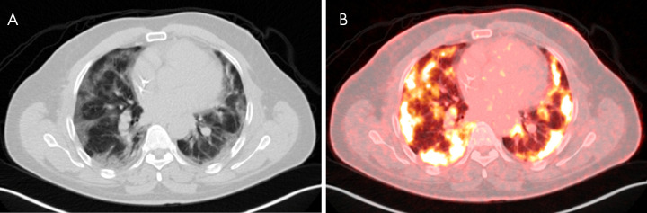 Images in 33-year-old man with history of human immunodeficiency virus and treated Hodgkin lymphoma undergoing PET/CT for oncologic restaging. B, Fused PET/CT imaging shows bilateral peripheral-predominant intense sites of fluorodeoxyglucose avidity that correspond to ground-glass and mixed attenuation opacities on A, CT scans. A maximum standardized uptake value of 9.98 was seen. The patient was asymptomatic at time of imaging but presented to the emergency department 10 days later after developing hypoxia with 85% oxygen saturation on room air. The patient was confirmed to be positive for coronavirus disease 2019 with polymerase chain reaction testing.