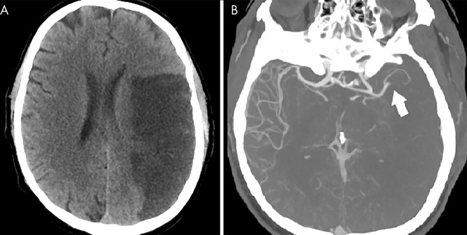 Cerebral arterial thrombosis in coronavirus disease 2019 (COVID-19). A, Non–contrast-enhanced head CT scan in a 57-year-old man with COVID-19 demonstrates hypoattenuation throughout the left middle cerebral artery territory. B, CT angiogram in the same patient demonstrates focal occlusion of the left M2 branch (arrow) without distal reconstitution.