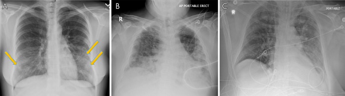 A, Posteroanterior chest radiograph in a 29-year-old woman with no past medical history, who presented to the emergency department with 4 days of fever, cough, pleuritic chest pain, diarrhea, and myalgias, shows faint peripheral rounded opacities in a lower lung distribution (arrows). B, Chest radiograph in a 40-year-old man with a history of diabetes mellitus who presented from a group home with fever, cough, and shortness of breath of duration 1 week demonstrates diffuse bilateral opacities with dense consolidation in the mid to lower lungs. C, Portable chest radiograph in an intubated 50-year-old man with a history of hypertension who presented with 1 week of fever, cough, congestion, and myalgias. On his 7th day of admission, 14 days after symptom onset, chest radiograph demonstrates multiple bilateral diffuse hazy pulmonary opacities. The patient was noted to have elevated inflammatory markers including C-reactive protein, interleukin-6, d-dimer, lactate dehydrogenase, and fibrinogen. All patients were confirmed positive for coronavirus disease 2019 with polymerase chain reaction testing, and the patient in C died two days later.