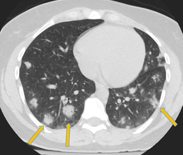 Corresponding axial chest CT scan without intravenous contrast material in patient in Figure 1 shows typical findings of coronavirus disease 2019 with peripheral and lower lobe–predominant dense consolidative opacities with a rounded morphology and mild surrounding ground-glass opacification (arrows).